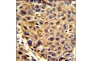 Formalin-fixed and paraffin-embedded human hepatocarcinoma reacted with SPCS3 Antibody (C-term), which was peroxidase-conjugated to the secondary antibody, followed by DAB staining. (SPCS3 antibody  (C-Term))