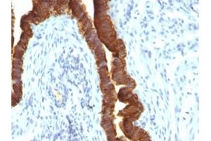 Formalin-fixed, paraffin-embedded human Ovarian Carcinoma stained with EpCAM Mouse Recombinant Monoclonal Antibody (rEGP40/1110). (Recombinant EpCAM antibody  (Cytoplasmic Domain))