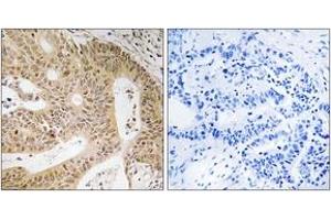 Immunohistochemistry analysis of paraffin-embedded human colon carcinoma tissue, using DAP Antibody.