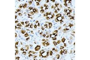 Immunohistochemical analysis of PRG2 staining in human gastric cancer formalin fixed paraffin embedded tissue section. (PRG2 antibody)