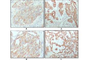 Immunohistochemical analysis of paraffin-embedded human breast carcinoma (A), lung cancer (B) and ovarian cancer tissue (C), showing membrane and cytoplasmic localization with DAB staining using CK8 mouse mAb. (KRT8 antibody)