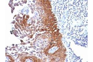 Formalin-fixed, paraffin-embedded human cervical carcinoma stained with Cytokeratin 18 antibody. (Cytokeratin 18 antibody)