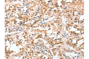 The image on the left is immunohistochemistry of paraffin-embedded Human thyroid cancer tissue using ABIN7128947(CIDEC Antibody) at dilution 1/50, on the right is treated with fusion protein. (CIDEC antibody)