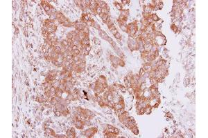 IHC-P Image Immunohistochemical analysis of paraffin-embedded human breast cancer, using PIM2, antibody at 1:250 dilution. (PIM2 antibody  (Center))