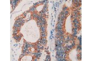 IHC-P analysis of Human Rectum Cancer Tissue, with DAB staining. (Prolactin Receptor antibody  (AA 25-234))