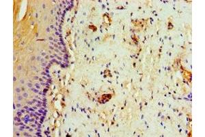Immunohistochemistry of paraffin-embedded human cervical cancer using ABIN7144328 at dilution of 1:100 (TAP1 antibody  (AA 524-808))