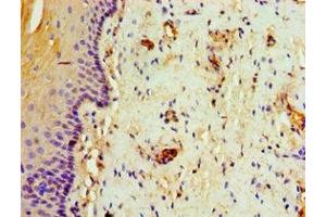 Immunohistochemistry of paraffin-embedded human cervical cancer using ABIN7144328 at dilution of 1:100
