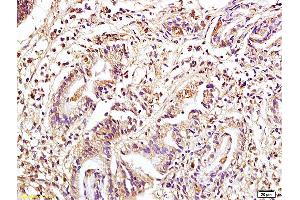 Formalin-fixed and paraffin embedded human colon carcinoma tissue labeled with Anti Phospho-MAP3K8/Tpl2 (Ser400) Polyclonal Antibody, Unconjugated (ABIN746573) at 1:200 followed by conjugation to the secondary antibody and DAB staining.