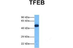 Host:  Rabbit  Target Name:  TFEB  Sample Tissue:  Human Lung Tumor  Antibody Dilution:  1. (TFEB antibody  (Middle Region))