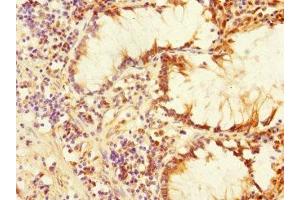Immunohistochemistry of paraffin-embedded human colon cancer using ABIN7169162 at dilution of 1:100 (PLK3 antibody  (AA 487-646))