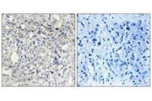 Immunohistochemistry analysis of paraffin-embedded human liver carcinoma tissue, using Heparin Cofactor II antibody. (SERPIND1 antibody)