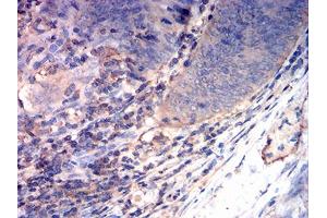 Immunohistochemical analysis of paraffin-embedded rectum cancer tissues using CD163 mouse mAb with DAB staining. (CD163 antibody  (AA 42-259))