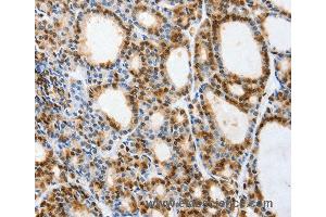 Immunohistochemistry of Human thyroid cancer using VIMP Polyclonal Antibody at dilution of 1:40 (Selenoprotein S antibody)