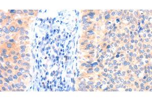 Immunohistochemistry of paraffin-embedded Human cervical cancer tissue using ANK3 Polyclonal Antibody at dilution 1:50 (Ankyrin G antibody)
