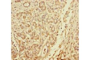 Immunohistochemistry of paraffin-embedded human pancreatic cancer using ABIN7145610 at dilution of 1:100 (Pallidin antibody  (AA 1-170))