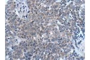 Immunohistochemistry of paraffin-embedded human thyroid cancer using ABIN7190935 at dilution of 1:20 (HES1 antibody)