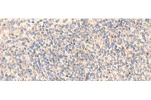 Immunohistochemistry of paraffin-embedded Human tonsil tissue using ADAMTS2 Polyclonal Antibody at dilution of 1:45(x200) (Adamts2 antibody)