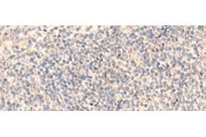 Immunohistochemistry of paraffin-embedded Human tonsil tissue using ADAMTS2 Polyclonal Antibody at dilution of 1:45(x200) (Adamts2 antibody)