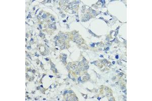 Immunohistochemistry of paraffin-embedded human mammary cancer using SOCS5 antibody (ABIN6128734, ABIN6148271, ABIN6148272 and ABIN6223959) at dilution of 1:100 (40x lens). (SOCS5 antibody  (AA 1-140))