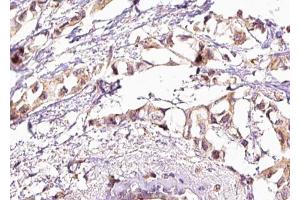ABIN6267581 at 1/100 staining human breast carcinoma tissue sections by IHC-P. (HSF1 antibody  (pSer303))