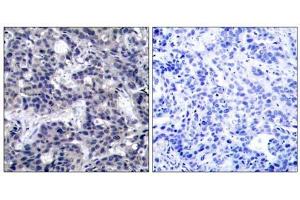 Immunohistochemical analysis of paraffin-embedded human breast carcinoma tissue using PKR (Ab-446) antibody (E021272). (EIF2AK2 antibody)