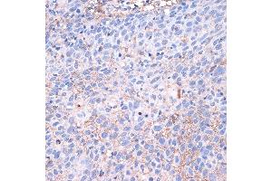 Immunohistochemistry of paraffin-embedded human esophageal cancer using PD-L1/CD274 Rabbit pAb (ABIN6129976, ABIN6138153, ABIN6138154 and ABIN6215142) at dilution of 1:100 (40x lens). (PD-L1 antibody  (AA 19-238))
