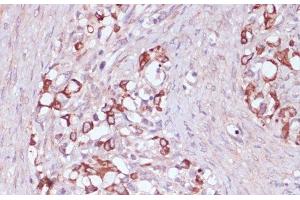 Immunohistochemistry of paraffin-embedded Human oophoroma using UGT2B15 Polyclonal Antibody at dilution of 1:100 (40x lens). (UGT2B15 antibody)