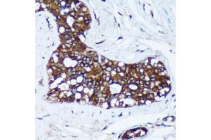 Immunohistochemistry of paraffin-embedded Human breast cancer using MRPL30 Rabbit pAb (ABIN7268567) at dilution of 1:100 (40x lens). (MRPL30 antibody  (AA 1-161))