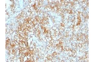 IHC testing of FFPE human renal cell carcinoma with CD147 antibody (clone 8D6). (CD147 antibody)