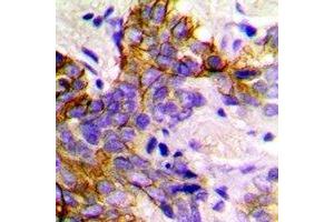Immunohistochemical analysis of GABARAP staining in human breast cancer formalin fixed paraffin embedded tissue section. (GABARAP antibody)