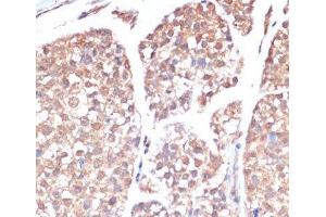 Immunohistochemistry of paraffin-embedded Human gastric cancer using PRMT7 Polyclonal Antibody at dilution of 1:200 (40x lens). (PRMT7 antibody)