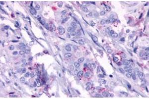 Immunohistochemistry (Formalin/PFA-fixed paraffin-embedded sections) of human colon cancer, neoplastic cells with GPR124 polyclonal antibody . (GPR124 antibody  (Extracellular Domain))