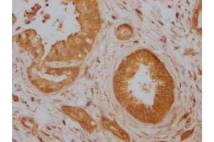 IHC image of ABIN7127414 diluted at 1:100 and staining in paraffin-embedded human pancreatic cancer performed on a Leica BondTM system. (Recombinant CDC42 antibody)