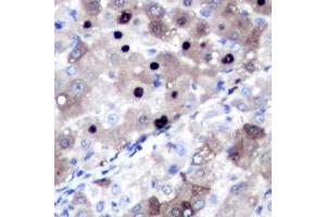 Immunohistochemical analysis of Topoisomerase 2 alpha staining in human liver cancer formalin fixed paraffin embedded tissue section. (Topoisomerase II alpha antibody  (N-Term))