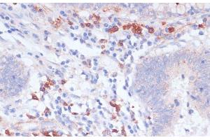 Immunohistochemistry of paraffin-embedded Human colon carcinoma using VASP Polyclonal Antibody at dilution of 1:100 (40x lens). (VASP antibody)