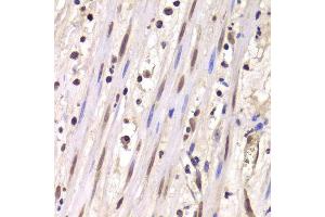 Immunohistochemistry of paraffin-embedded human mammary cancer using LSM4 antibody. (LSM4 antibody  (AA 1-139))