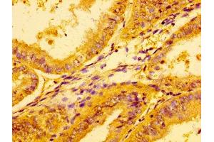 Immunohistochemistry of paraffin-embedded human endometrial cancer using ABIN7157794 at dilution of 1:100 (Lactate Dehydrogenase A antibody  (AA 5-323))