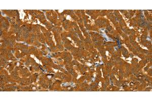 Immunohistochemistry of paraffin-embedded Human thyroid cancer using PYGM Polyclonal Antibody at dilution of 1:30 (PYGM antibody)