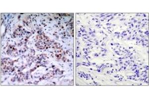 Immunohistochemistry analysis of paraffin-embedded human breast carcinoma, using NF-kappaB p65 (Phospho-Thr435) Antibody. (NF-kB p65 antibody  (pThr435))