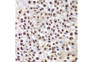 Immunohistochemistry of paraffin-embedded mouse cancer using SMARCB1 antibody. (SMARCB1 antibody)
