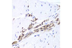 Immunohistochemistry of paraffin-embedded Human gastric cancer using TPPP3 antibody at dilution of 1:100 (x400 lens).
