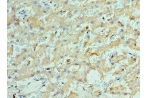 Immunohistochemistry of paraffin-embedded human liver cancer using ABIN7157649 at dilution of 1:100 (KIF2C antibody  (AA 1-190))