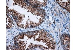 Immunohistochemical staining of paraffin-embedded Carcinoma of liver tissue using anti-FAHD2A mouse monoclonal antibody. (FAHD2A antibody)