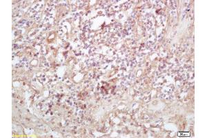 Formalin-fixed and paraffin embedded human lung carcinoma labeled with Rabbit Anti Exportin 1/CRM1 Polyclonal Antibody, Unconjugated (ABIN1714155) at 1:200 followed by conjugation to the secondary antibody and DAB staining (XPO1 antibody  (AA 701-800))