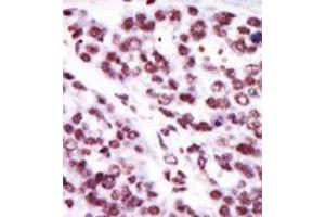 Formalin-fixed and paraffin-embedded human cancer tissue reacted with the primary antibody, which was peroxidase-conjugated to the secondary antibody, followed by AEC staining. (PKC epsilon antibody  (N-Term))