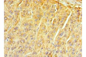Immunohistochemistry of paraffin-embedded human liver cancer using ABIN7161741 at dilution of 1:100 (NTRK3 antibody  (AA 40-300))