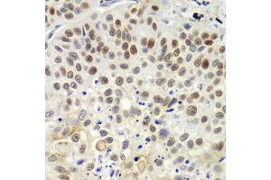 Immunohistochemistry of paraffin-embedded human lung cancer using MSH6 antibody at dilution of 1:100 (400x lens). (MSH6 antibody)