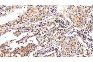 Detection of RNASE3 in Human Lung cancer Tissue using Polyclonal Antibody to Ribonuclease A3 (RNASE3) (RNASE3 antibody  (AA 30-154))