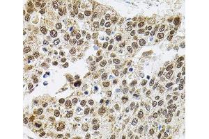 Immunohistochemistry of paraffin-embedded Human lung cancer using BAF60a Polyclonal Antibody at dilution of 1:100 (40x lens). (SMARCD1 antibody)