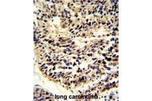Formalin-fixed and paraffin-embedded human lung carcinoma reacted with BCL2A1 Antibody (Center), which was peroxidase-conjugated to the secondary antibody, followed by DAB staining. (BCL2A1 antibody  (Middle Region))
